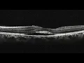 Photodynamic Therapy in Chronic Central Serous Chorioretinopathy Retina Center Tijuana Mexico