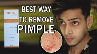 Best Way To Remove Pimple And Acne