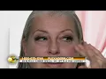 Plexaderm results are incredible and you can use this with makeup