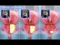 What is the TULSA-PRO TULSA Procedure Profound Medical