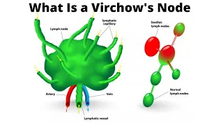 What Is a Virchow s Node