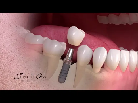 Download MP3 Single Tooth Implant