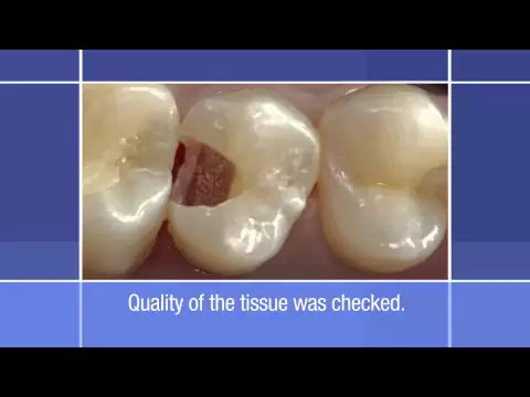 Download MP3 Posterior Restoration: Using a Dual-Shade Technique to Perform a Class II Restoration