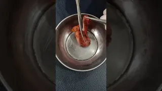 استئصال المرارة بالمنظار الجزء٥ د عاطف حايس 