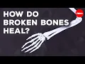 What happens when you break a bone - Gurpreet Baht and Natalie Pang
