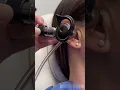 Download Lagu How an ENT Doctor Removes Ear Wax