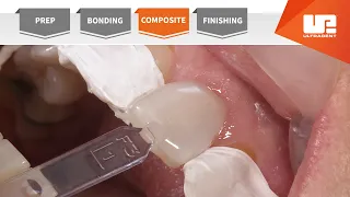Composite Your Complete Restorative Solution