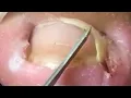 Download Lagu Poor Toe Has Severe Ingrown Toenail, Treatment For Paronychia【Crazy pedicure room】