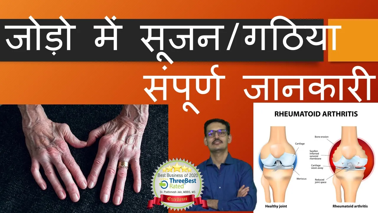 Rheumatoid Athritis hindi जोड़ो में सूजन : संधि वा / गठिया के बारे में संपूर्ण जानकारी