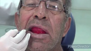 clinical steps for jrr