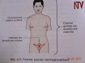 Health Focus Dealing with ambiguous genitalia in intersex children