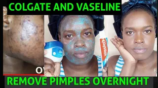 Download How to remove pimples and blackheads overnight | Colgate and Vaseline facemask MP3