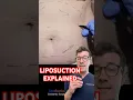 Doctor explains LIPOSUCTION for weight loss