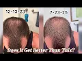 HIMS vs Happy Head Hair Growth Real Results My Switch Explained