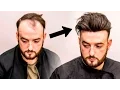 Download Mens Hair Loss Treatment | Hairstyle Transformation - Does it Work? mp4 3gp mp3 videos - waplic