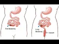 Ileostomy CPT code - simplify medical coding