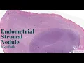 Endometrial Stromal Nodule