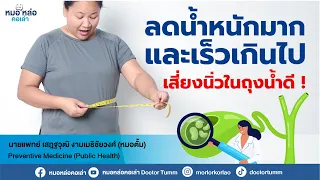 ทำไมการลดน้ำหนักเร็วๆ ถึงเพิ่มความเสี่ยงต่อการเกิดนิ่วในถุงน้ำดี