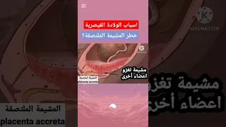الولادة القيصرية وخطر المشيمة الملتصقة  الولادة الطبيعية  الولادة القيصرية  الولادة  صحة دندنها