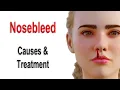 Nosebleed Causes and Treatment