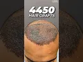 Download Lagu 4450 Hair Grafts | Sapphire FUE Hair Transplant By Dr. Mohd Asif at CARA