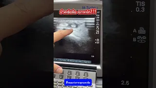  ทำไมคนไข้ถึงมีอาการปวดข้อมือและบวมที่บริเวณนั้น 