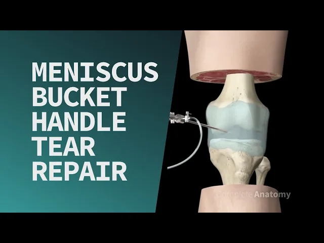 Meniscus Bucket Handle Tear Repair