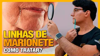 LINHAS DE MARIONETE | Como tratar?