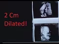 2cm Dilated 3d ultrasound