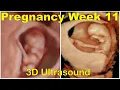 pregnancy week 11 week 11 Ultrasound 3D Ultrasound