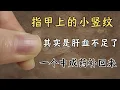 Download Lagu 指甲上的小竖纹其实是肝血不足了一个中成药补回来 ！| 中医养生｜身体调理｜气血疏通｜经络养生｜针灸理疗｜【中医针灸理疗师Jimmy】
