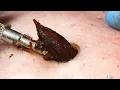Download Lagu [ASMR] Sharp Ingrown Trimmed! Professional Pedicure DR LEE’S ULTIMATE ZITPOPPER #Satisfying #050707