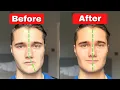 Download Lagu How to Fix Asymmetrical Jaw \u0026 Face (TODAY!)