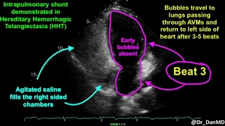 Pulmonary Arteriovenous Malformations AVMs in HHT