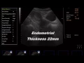 Endometrial thickness 22mm