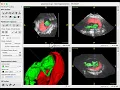 Demo of new Deep Learning Segmentation in ITK-SNAP 4 4