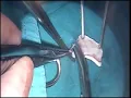 Download Lagu MV repair with pericardial patch in IE
