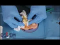 ECREM FOAMed - Incision Drainage