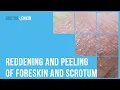 Reddening and peeling of foreskin and scrotum