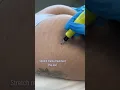 Stretch Marks Inkless Removal Boleyn Treatment Los Angeles