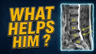 How to fix l4 - L5 disc herniation #discherniation