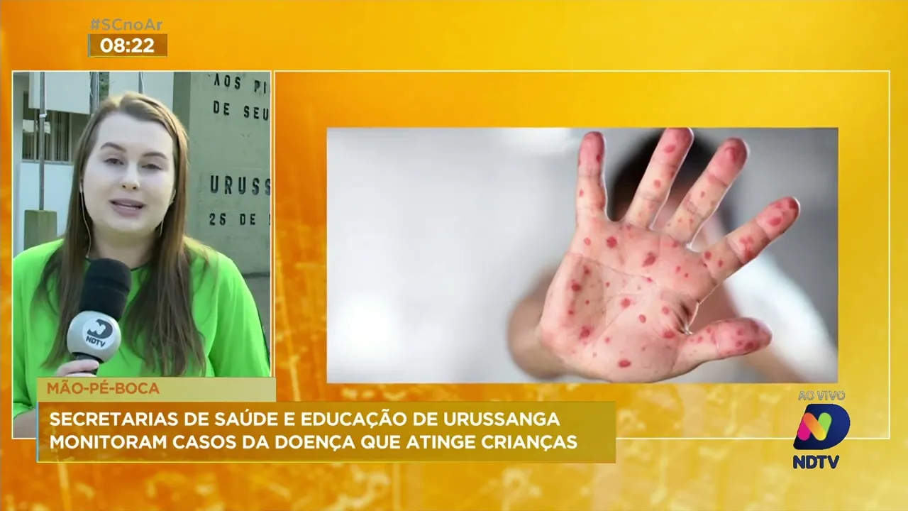 Secretarias da saúde e da educação de Urussanga intensificam monitoramento da doença 'mão-pé-boca'