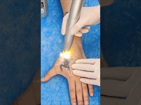 Tattoo Removal ऐसे होता है 😯