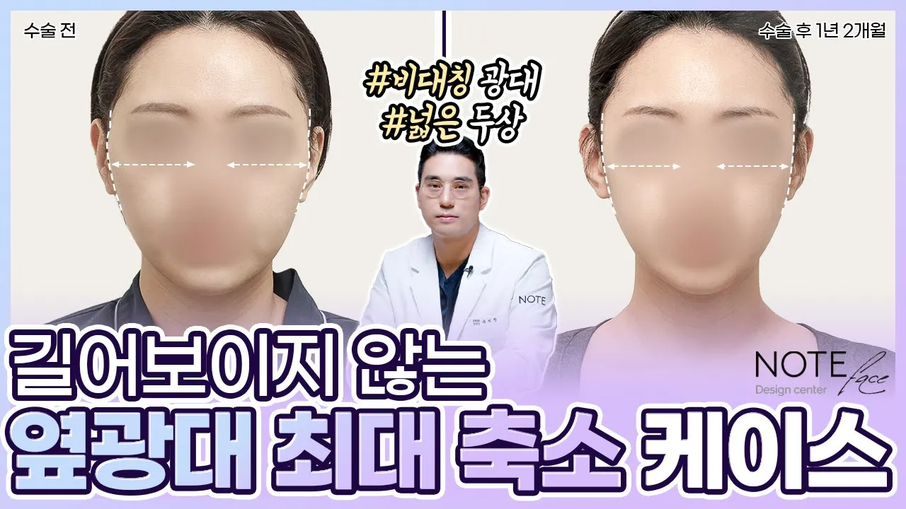 [유.케.리] 📍 CT로 보는 케이스 리뷰 l 두상 크기와 광대 l 옆광대 l 광대 축소 l