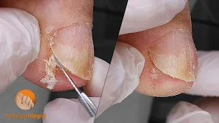 Toenail cleaning to make the patient feel comfortable when putting on footwear | Podología Integral