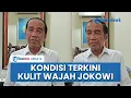 Download Lagu Perubahan Kulit Wajah Jokowi Menuai Kontroversi, Ajudan: Medis Masih Lakukan Tahap Pemulihan Alergi