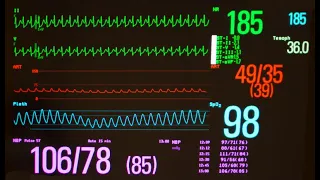 Pediatric Tachycardia and PALS What You Need to Know
