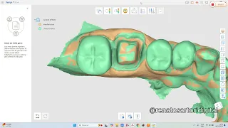 Recorte de preparo dentário quando há falta de contato proximal