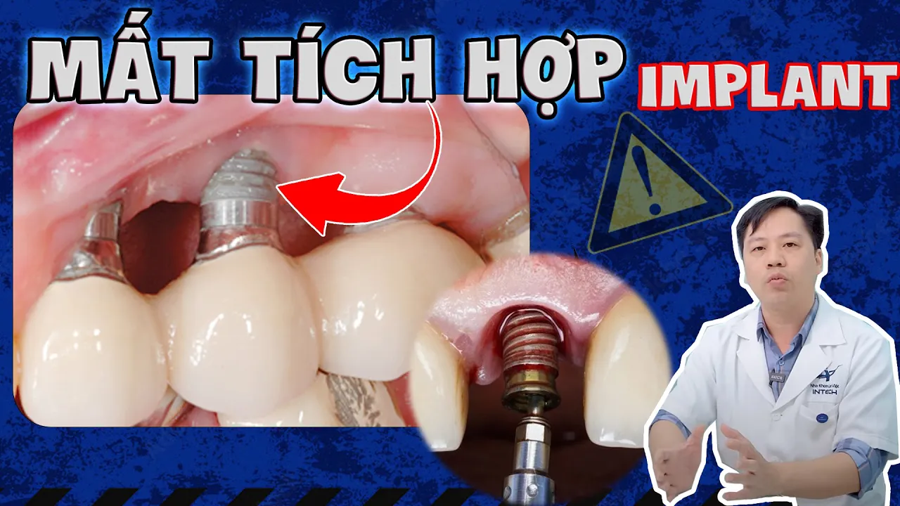 Outline Video Mất Tích Hợp Implant: 03 Nguyên Nhân Khó Ngờ Và Cách Xử Lý "Cấp Tốc" Tránh Rủi Ro Sức Khoẻ
