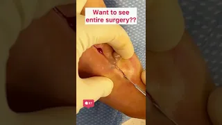 Draining Pus From Foot Infection Shorts 